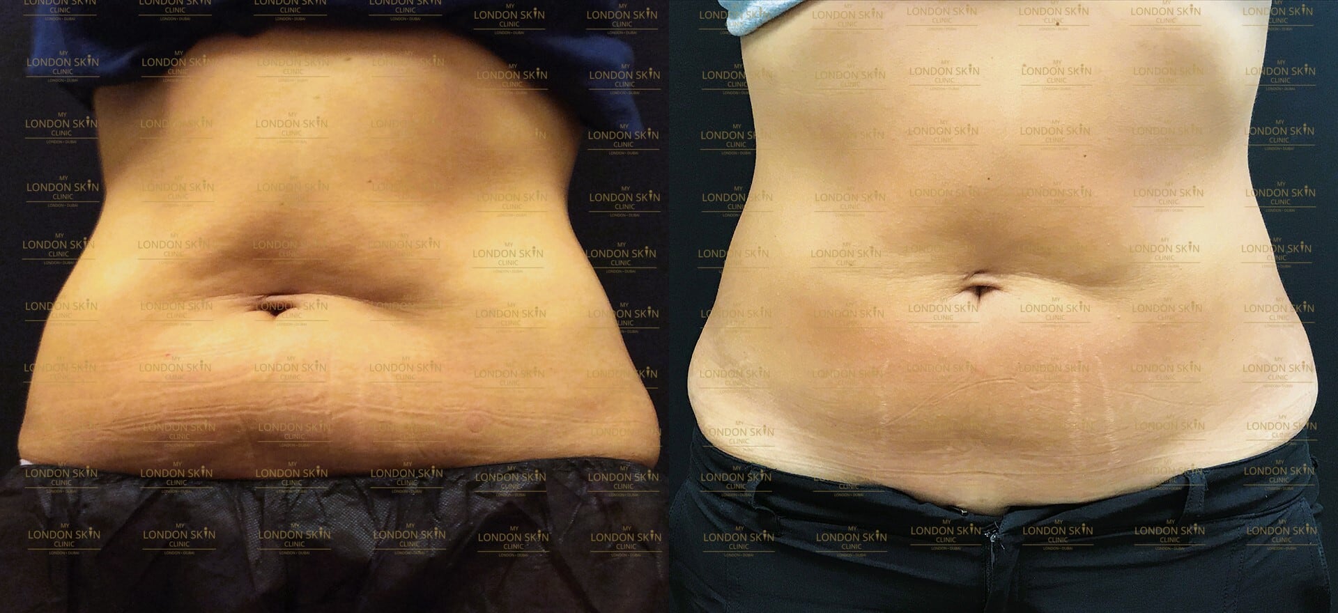 Liposuction in Dubai